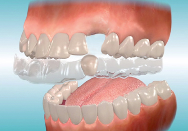 Replacing Missing Teeth Saskatoon SK Replace Tooth